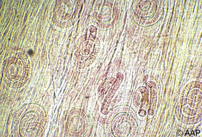 Šilutėje nuo šernienos kilo trichineliozės protrūkis